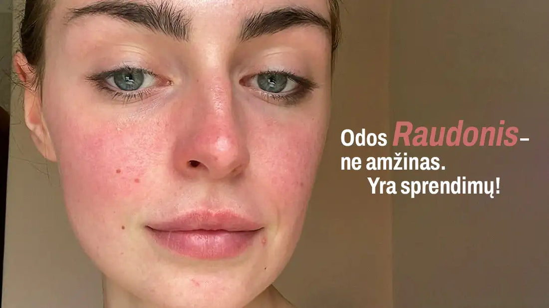 Veido raudonis ir rožinė – kaip nuraminti odą ir sustiprinti jos apsauginį barjerą