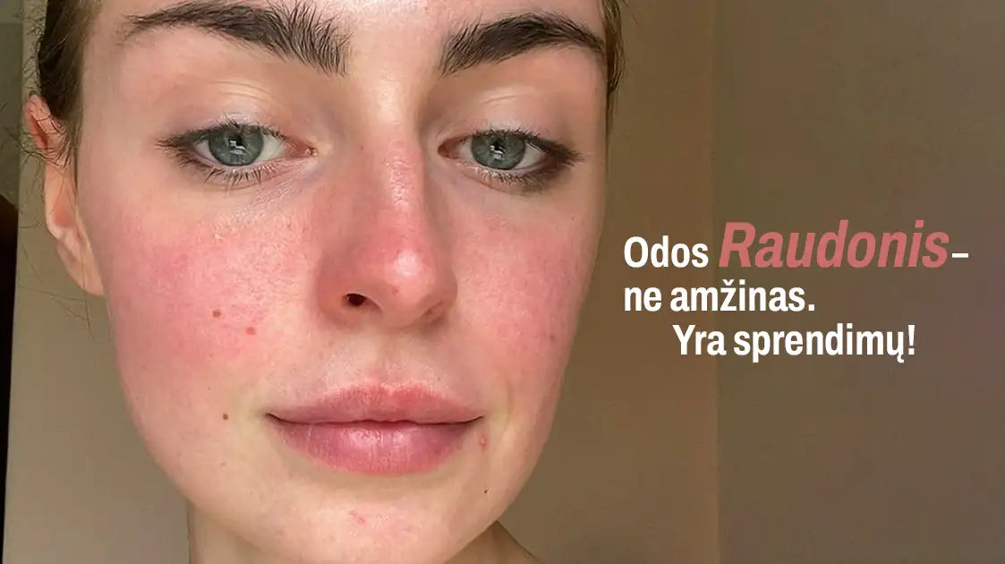 Veido raudonis ir rožinė – kaip nuraminti odą ir sustiprinti jos apsauginį barjerą