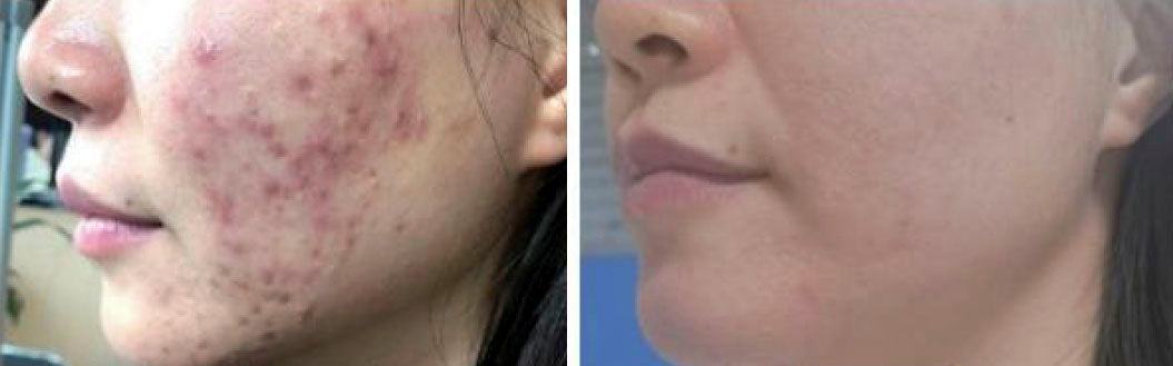 Pagrindiniai veido aknės gydymo principai