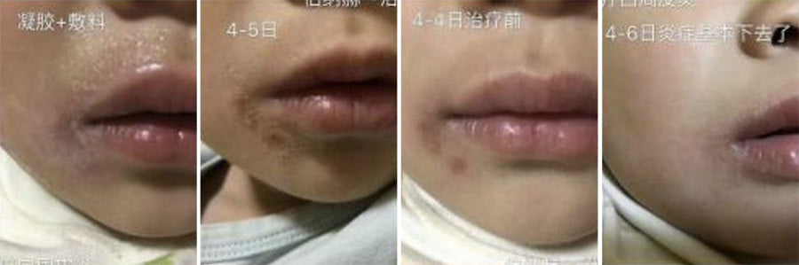 Pagrindiniai dermatito ir egzemos gydymo principai