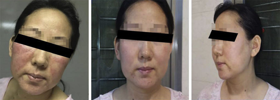 Pagrindiniai jautrios odos ir nuo hormonų priklausomo dermatito gydymo principai