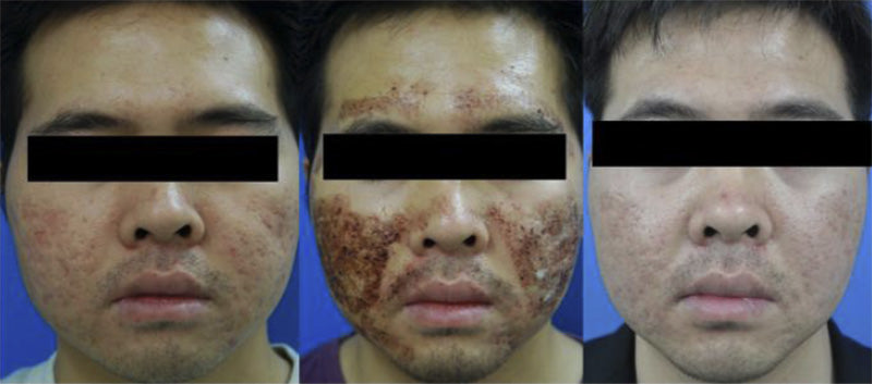 Pagrindiniai odos priežiūros principai po lazerinių procedūrų