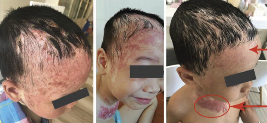 Pagrindiniai nudegimų ir nuplikymų gydymo principai