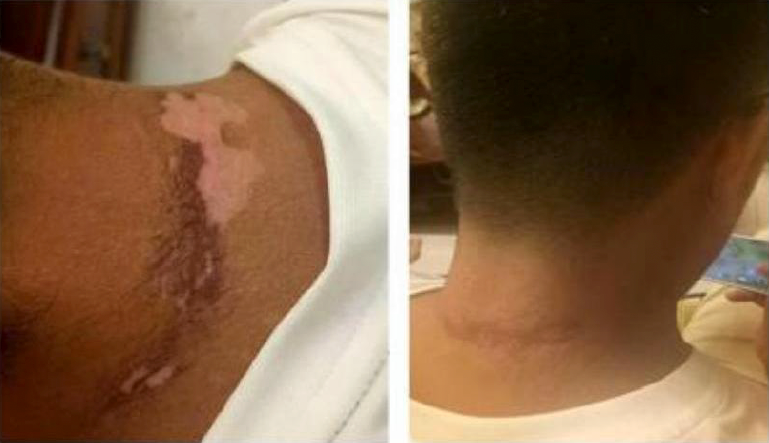 Pagrindiniai saulės nudegimo gydymo principai