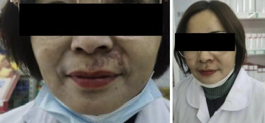 Pagrindiniai randų gydymo principai