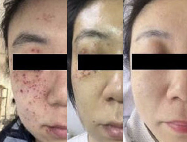 Ką naudoti po lazerinių ir plastinių procedūrų, kad oda gytų greičiau ir gražiau?