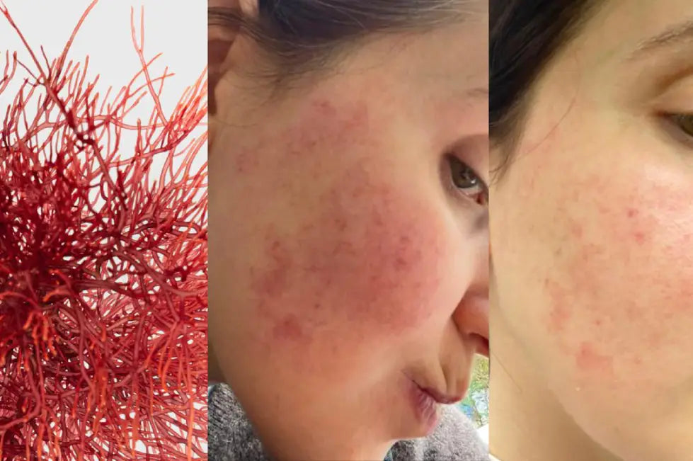 Suprasti Rožinę: Priežastys, Kam Tai Būdinga, Ir Kaip Tvarkytis