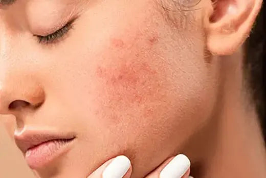 Seacra - gali būti efektyvi priemonė nuo rožinės, spuogų ir odos senėjimo požymių.