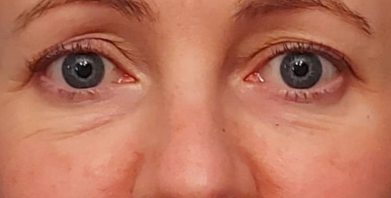 Luna Microcare LUMINANCE. Prieš ir Po