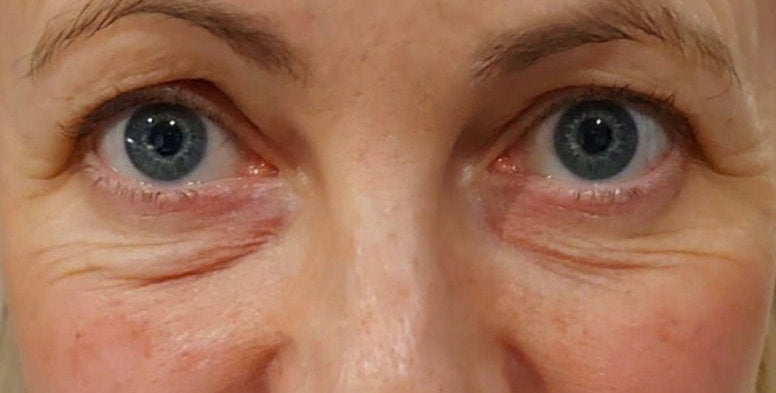 Luna Microcare LUMINANCE. Prieš ir Po