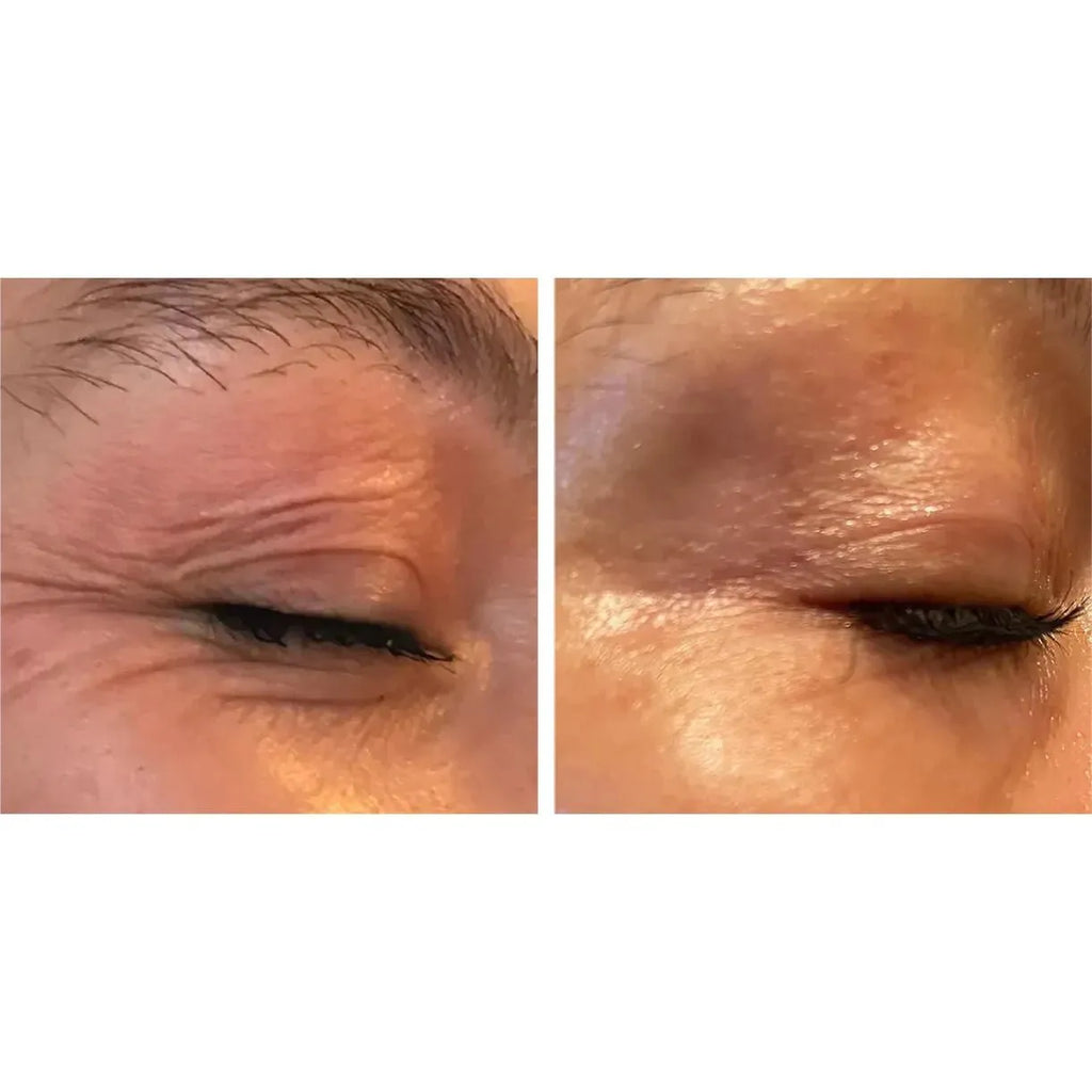 Luna Microcare Eternal ir Revive pleistrų rinkinys kovojantis su veido odos senėjimu. Paakių odos būklė prieš ir po procedūros
