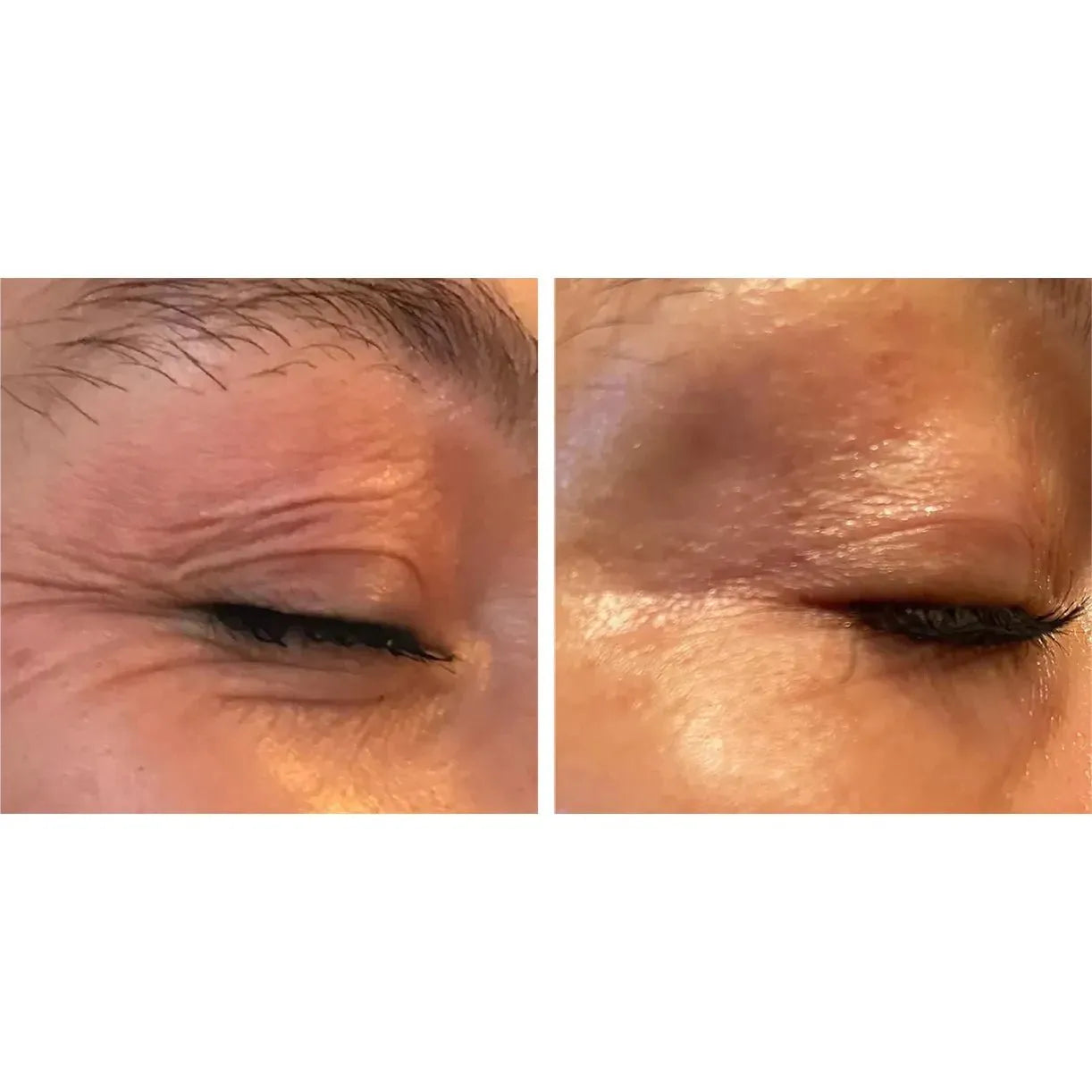 Luna Microcare Eternal ir Revive pleistrų rinkinys kovojantis su veido odos senėjimu. Paakių odos būklė prieš ir po procedūros