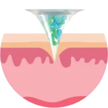 Luna Microcare Mikroadatiniai naktiniai pleistrai. Technologija. Adatėlės prasiskverbia.