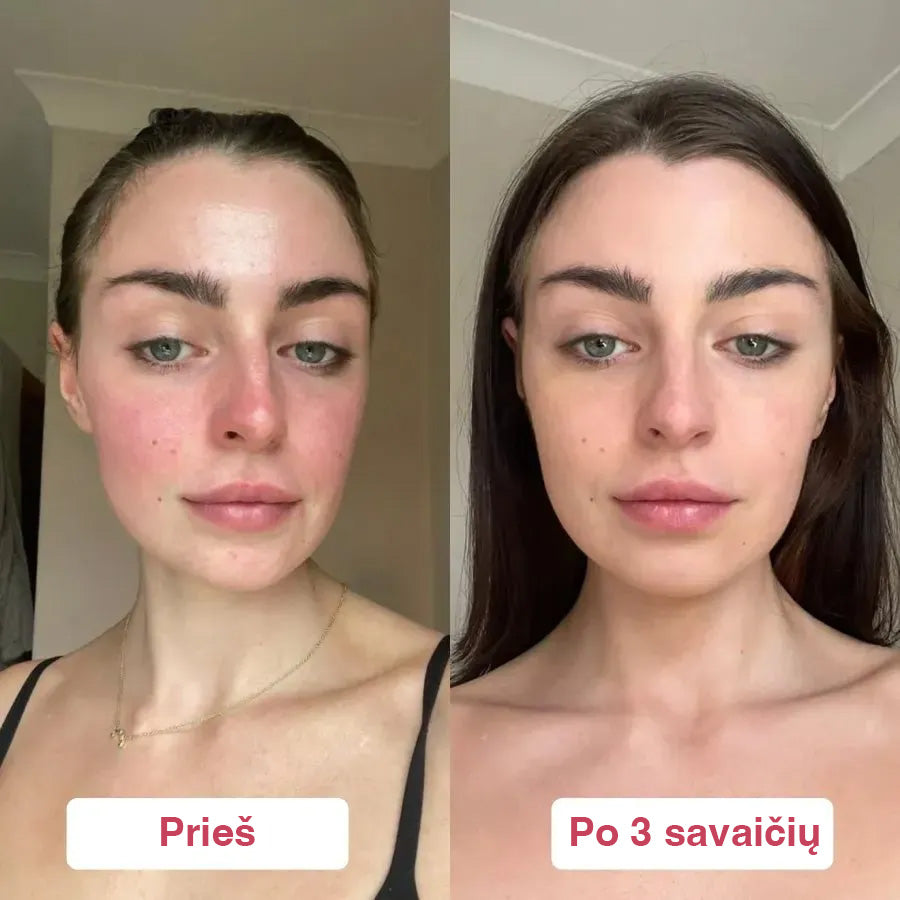 Atkuriamasis serumas–gelis raustančiai odai