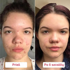 Seacra atkuriamasis serumas–gelis raustančiai odai prieš ir po 5 savaičių